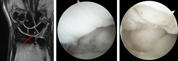 박리성 골연골염 미세천공술 수술 예 이미지