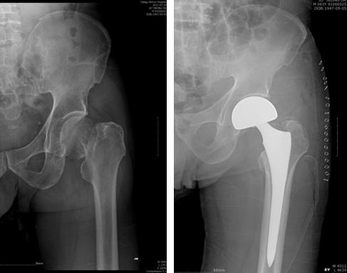 대퇴골 경부 골절에서 인공관절 부분 치환 수술 예 이미지