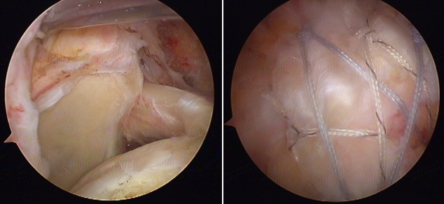 회전근개 대 파열에서 관절경적 봉합수술의 예 이미지
