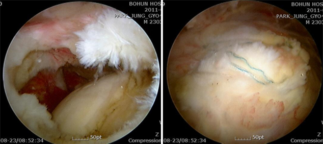 회전근개 복합 파열에서 관절경적 봉합수술의 예 이미지