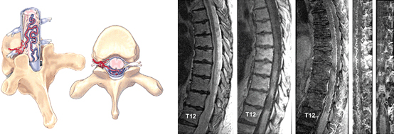 가장 흔한 형태의 척수 동정맥루(spinal dural AVF)의 모식도 및 자기공명영상 이미지