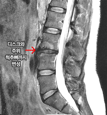 디스크와 주위 척추뼈까지 변성된 퇴행성 디스크질환 MRI 이미지