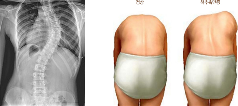 척추측만증 엑스레이, 정상과 척추측만증 비교 이미지