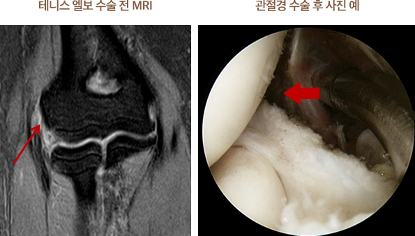 테니스 엘보 수술 전 MRI 사진과 관절경 수술 후 사진 예 이미지