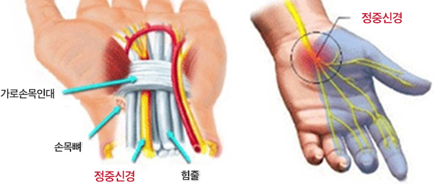 손목터널 증후군 설명 이미지