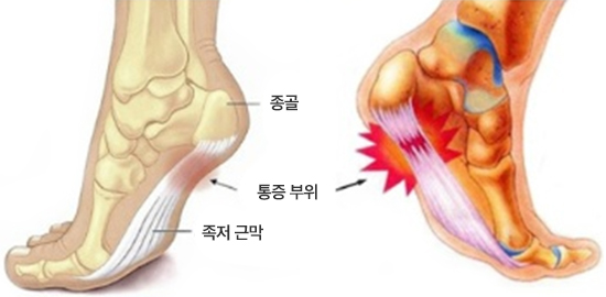 족저 근막염 이미지