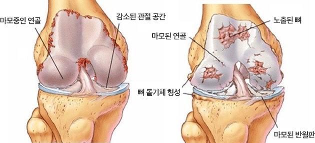 퇴행성 관절염 이미지