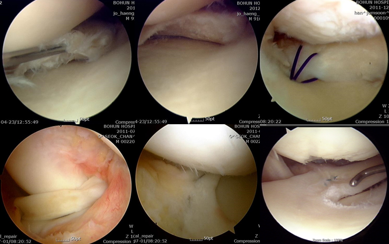 관절경적 반월상 연골판 파열의 부분 절제술 및 다양한 봉합 수술 예 이미지
