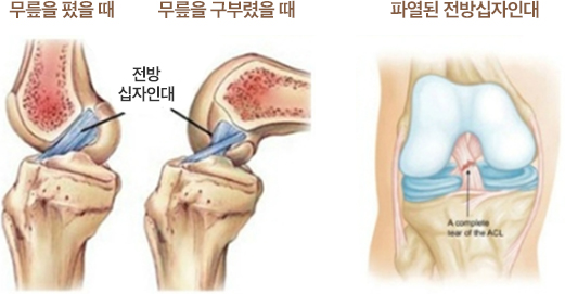 정상 전방십자인대와 파열된 전방십자인대 이미지