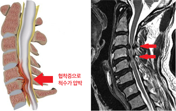 협착증으로 척수가 압박되는 이미지