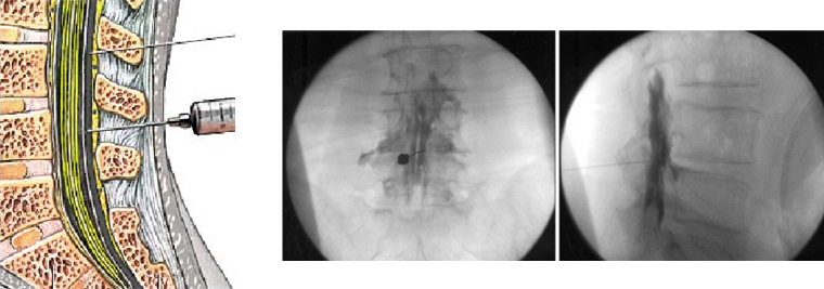 경막외 신경주사 이미지