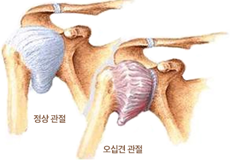 정상 관절과 오십견 관절 비교 이미지