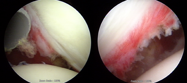 관절경적 유착 관절낭 절제 수술 예 이미지