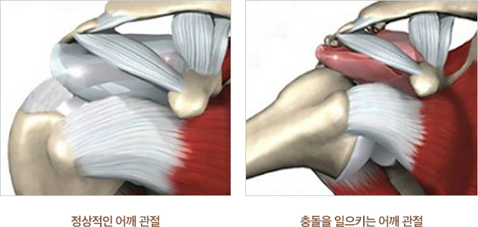 정상적인 어깨 관절과 충돌을 일으키는 어깨 관절 이미지