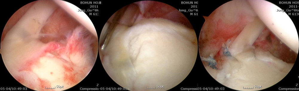 관절경적 슬랩병변 봉합 수술 예 이미지