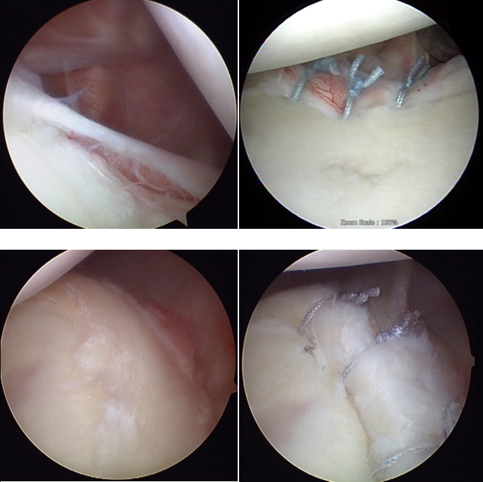 관절경적 방카르트 병변 봉합 수술 및 역 방카르트 병변 봉합 수술 예 이미지