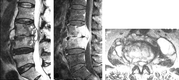 결핵성 척추염 MRI 이미지