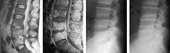 화농성 척추염 MRI 이미지