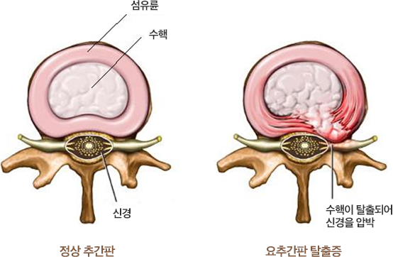 정상 추간판과 요추간판 탈출증 비교 이미지