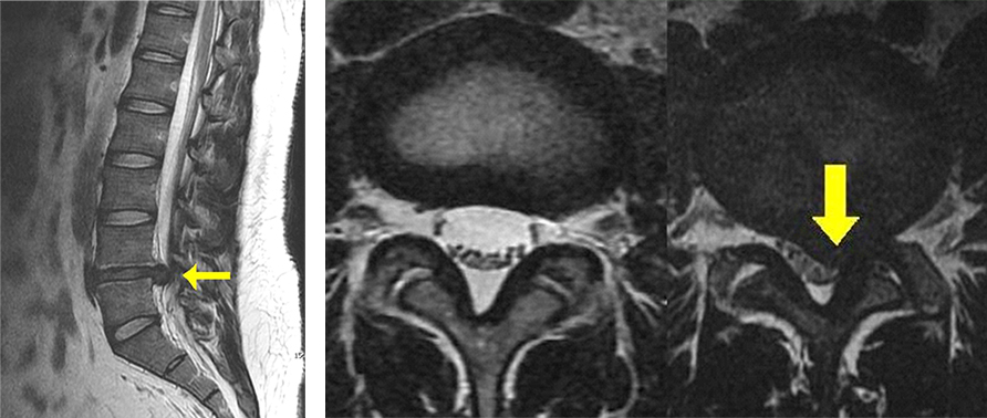 요추간판 탈출증 환자의 측면 MRI 및 단면 MRI 사진