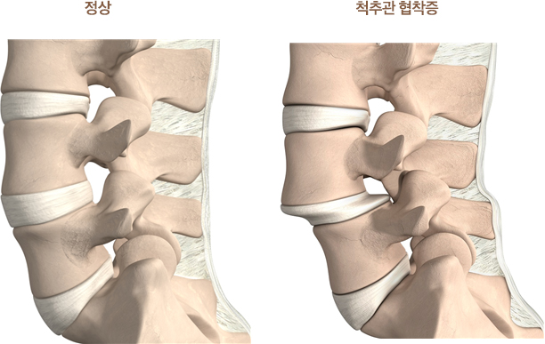 정상과 척추관 협착증이 있는 척추의 비교 이미지