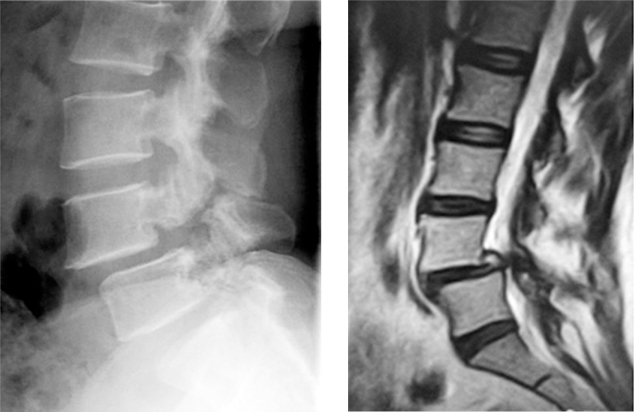 척추 전방 전위증 MRI 사진