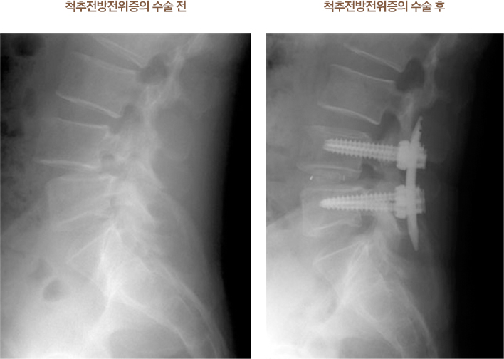 척추전방전위증의 수술 전,후 사진