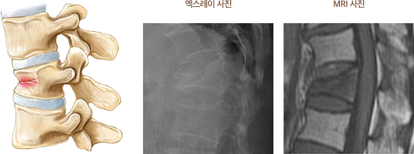 척추 압박골절 진단 엑스레이 및 MRI 사진