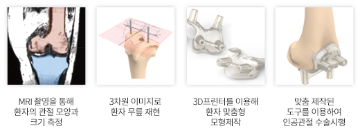 척척병원 환자 맞춤형 3D 인공관절 제작 과정 이미지 : 1.MRI 촬영을 통해 환자의 관절 모양과 크기 측정 → 2.3차원 이미지로 환자 무릎 재현 → 3.3D프린터를 이용해 환자 맞춤형 모형제작 → 4.맞춤 제작된 도구를 이용하여 인공관절 수술시행